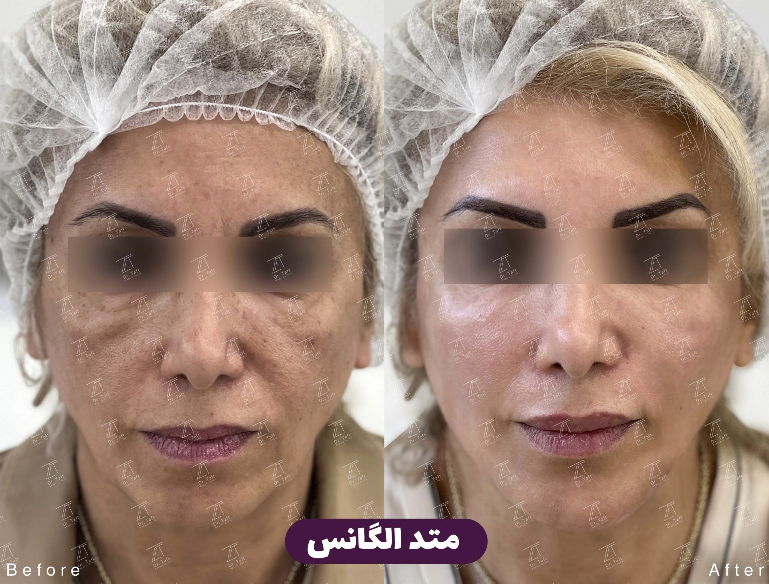 تزریق فیلر برای افراد دیابتی